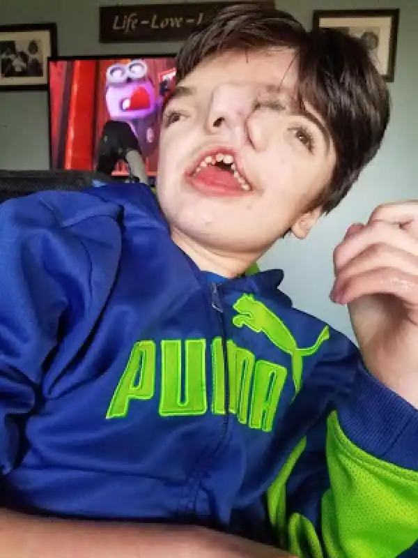 AMAZING!! Boy Born Two Faces Defies Odds To Celebrate His 13th Birthday See Shocking Photo